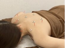 なつめ鍼灸ボディケアサロン/～全身鍼灸～