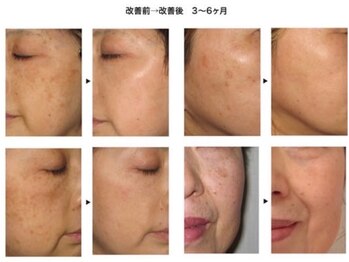 サロンドボーテ ノンノン(Salon de Beaute Non-non)/シミ・シワ改善 美肌コース