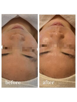 ココルーネ(COCORUNE)/シルク肌ハーブピーリング