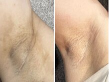 ハーモニー(harmony)/ローマピンク　ビフォーアフター