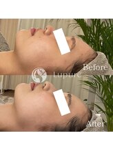 ルプレ(Lupure)/ハーブピーリング９回目