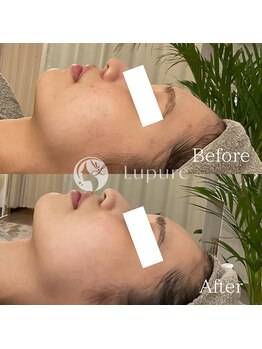 ルプレ(Lupure)/ハーブピーリング9回目