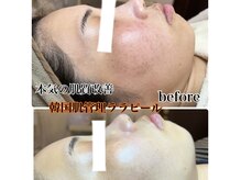 ラウレア(Laule'a)の雰囲気(話題沸騰中の韓国肌管理ララピール!剥離なしダウンタイムなし◎)