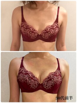 リール 新宿店(RIRE)/30代前半 バストアップ症例