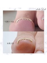 ネイル サロン アールズ ネイル(R's nail)/巻き爪ケア