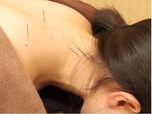 ビファイン鍼灸治療院 梅ヶ丘南口院/鍼施術