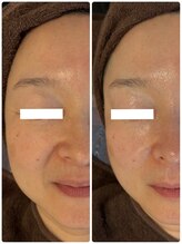 グラサヴォーグ 金沢店/お顔のハリが違う(*^^*)