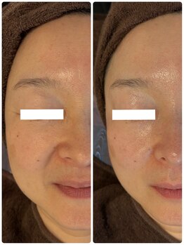 グラサヴォーグ 金沢店/お顔のハリが違う(*^^*)