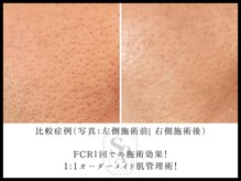 韓国肌管理室 ソア(soa)/【毛穴の違いに一目瞭然】
