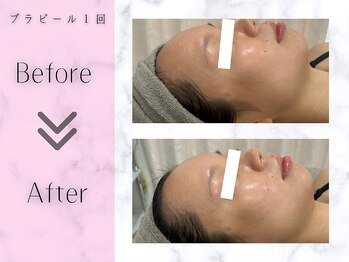 リライフ(ReLIFE)/韓国肌管理/毛穴洗浄+ララピール