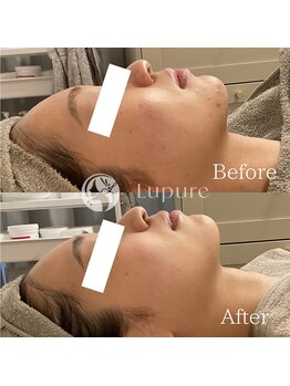 ルプレ(Lupure)/ハーブピーリング9回目