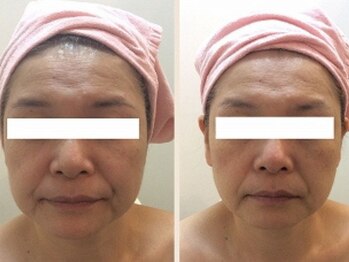 パトラ 難波店/ハーブピーリング★しわ改善症例