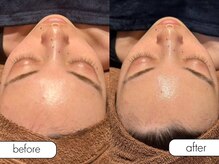 エステルーム ココ(COCO)/ミコステラ施術後