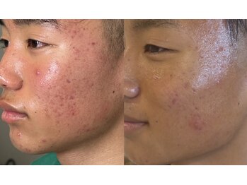 ベル(Belle)/学生肌質改善