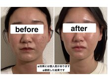 グリーン鍼灸整体院(green鍼灸整体院)/美容鍼（ビフォーアフター）