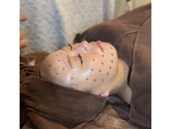 キセキ(KISEKI)の写真/【再生美容】ダウンタイム無しのハーブピーリング☆エクソソーム導入で即実感！