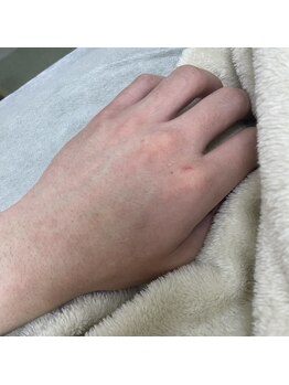 ナノハナ/鹿沼市の全身脱毛美容室ナノハナ