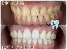 札幌セルフホワイトニング ラディアンス(Radiance)/プラチナム12回チケット
