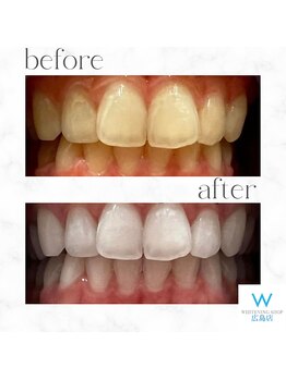 ホワイトニングショップ 広島店(WHITENING SHOP)/【ホワイトニング】Before After