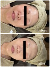 ジャスミン(Jasmin)/たるみ改善コース