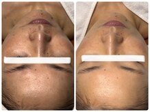 ベルドア(Bell Door)/ビタミン導入Aトリートメント