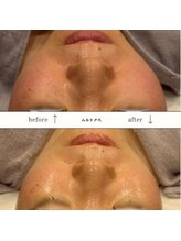 ビーエヌ エステティックアンドスパ(BN Esthetic&Spa)/40代毛穴の引き締めも◎