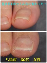 巻き爪じゅん 船橋店/巻き爪が1回でこんなに変わった