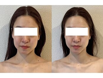 ミベル(MeBell)/【小顔コルギ】左右差の変化