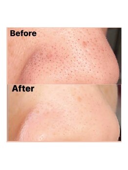 ホワイトニングジム アイス/一度でも毛穴スッキリを実感!