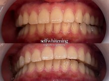 ココロビューティーギャラリー 武蔵小杉(cocorobeauty gallery)/ホワイトニング★初回4照射