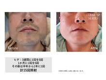 ザ エッセンシャル 碧南(THE Essential)/メンズ　ヒゲ脱毛