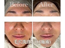 ミノア 熊本店(MINOA)/毛穴洗浄/毛穴/赤み