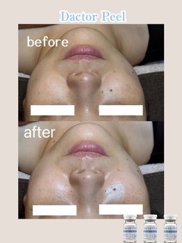 ベルシャトン(Belle Chaton)/ダクトピール