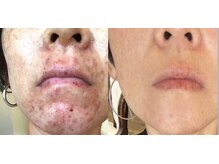 コンディションスキン(condition skin)の雰囲気(肌の常在菌バランスを整えると3ヶ月ぐらいでみるみる変化が♪)