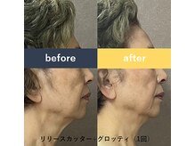 シュシュ(chouchou)/フェイシャル☆ビフォーアフター