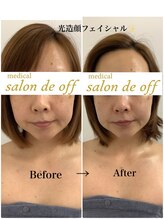 メディカルサロンドオフ 堺東店(medical salon de off)/光造顔フェイシャル★ &nbsp;施術前後