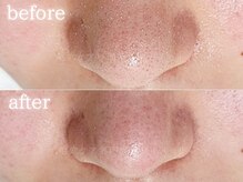 メモリ/お客様の変化/毛穴ケア