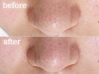 メモリ/お客様の変化/毛穴ケア