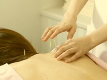 ブレア 元町/肩の鍼施術