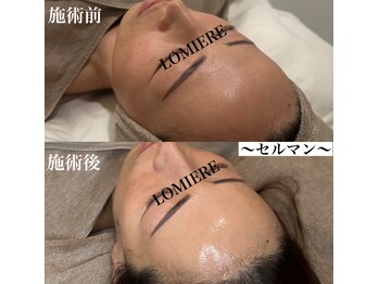 ロミエール 南草津店(LOMIERE)/セルマン　(美白、ツヤ肌)