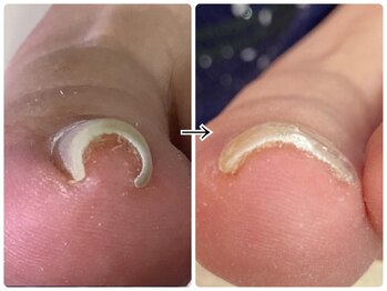 4回来店☆巻き爪ケア