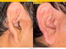 眉ダンディズム 大阪天神橋六丁目店/耳毛before/After