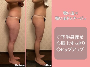 エステティックサロンティエリー/吸い玉×吸い玉ドレナージュ