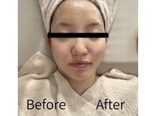 エミア(Emia)/フェイスラインをスッキリ！