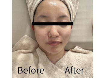 エミア(Emia)/フェイスラインをスッキリ！