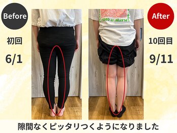 スロース鍼灸整体院(SLOTH鍼灸整体院)の写真/太ももの張り・膝の隙間とサヨナラ!プロの施術でO脚を根本改善!まっすぐで美しい脚線美を手に入れて★