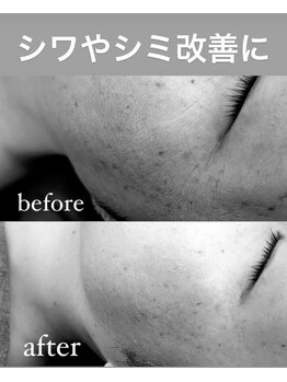 リノ(Lino)/プラズマフェイシャル