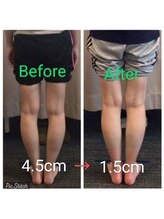 クシロ鍼灸整骨院/【O脚矯正】施術例