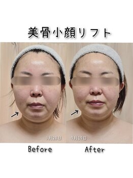 ラエッセス(A Laessess)/痩せた？って聞かれちゃう