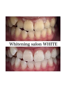 ホワイトニングサロン ホワイト 前橋店(WHITE)/ホワイトニングで印象アップ